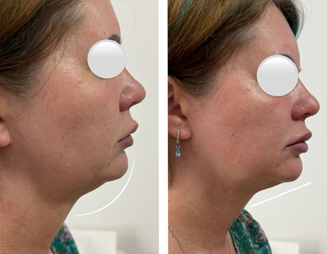 HIFU Facial - Contur mandibular rezultat