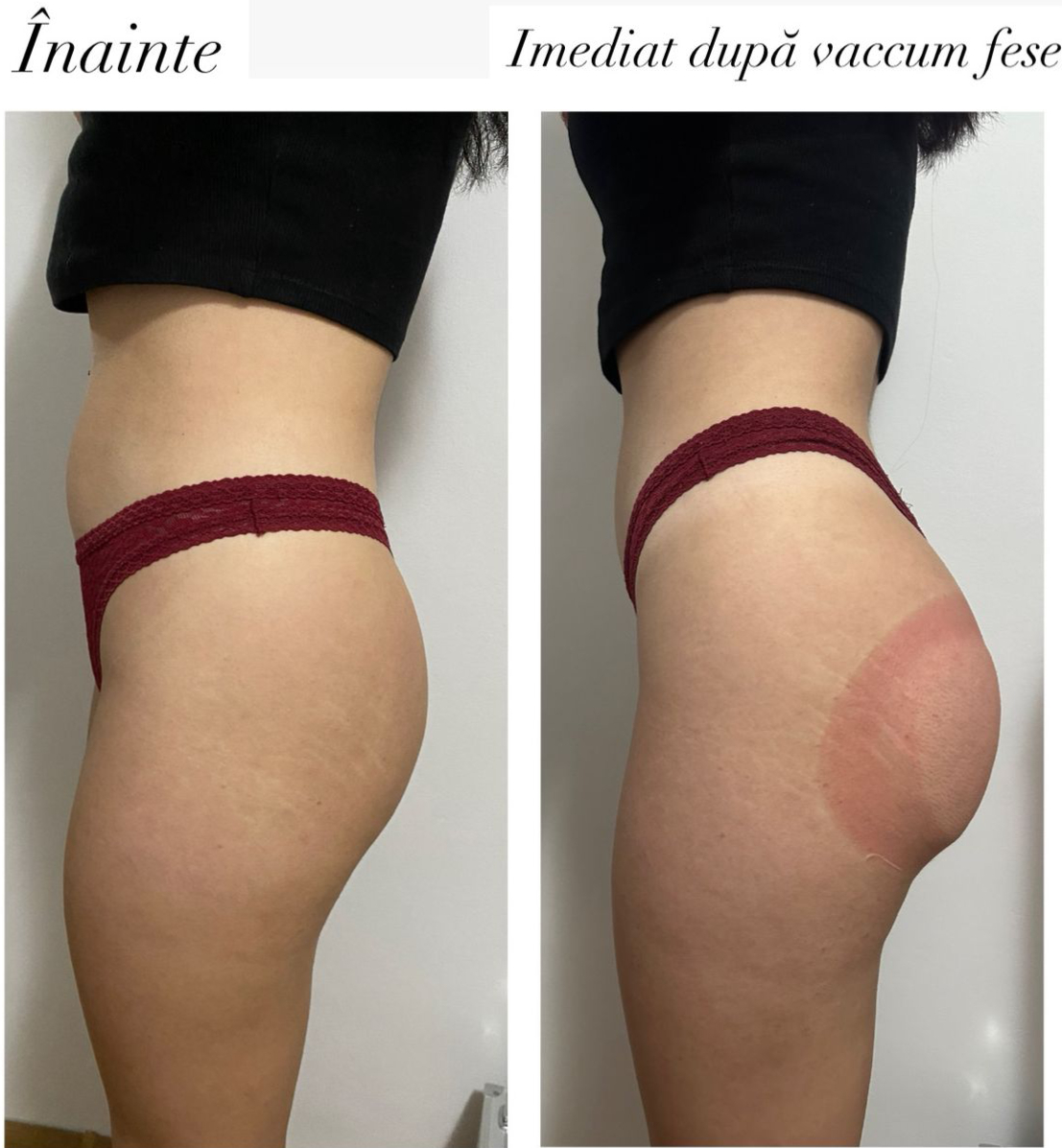 Vacuum Fese - imediat dupa