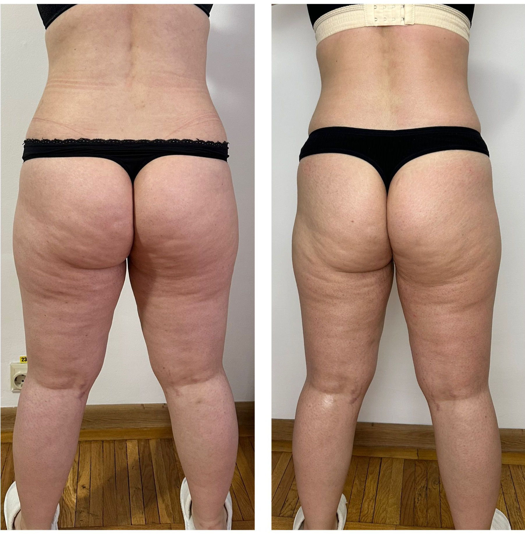 Remodelare coapse si picioare