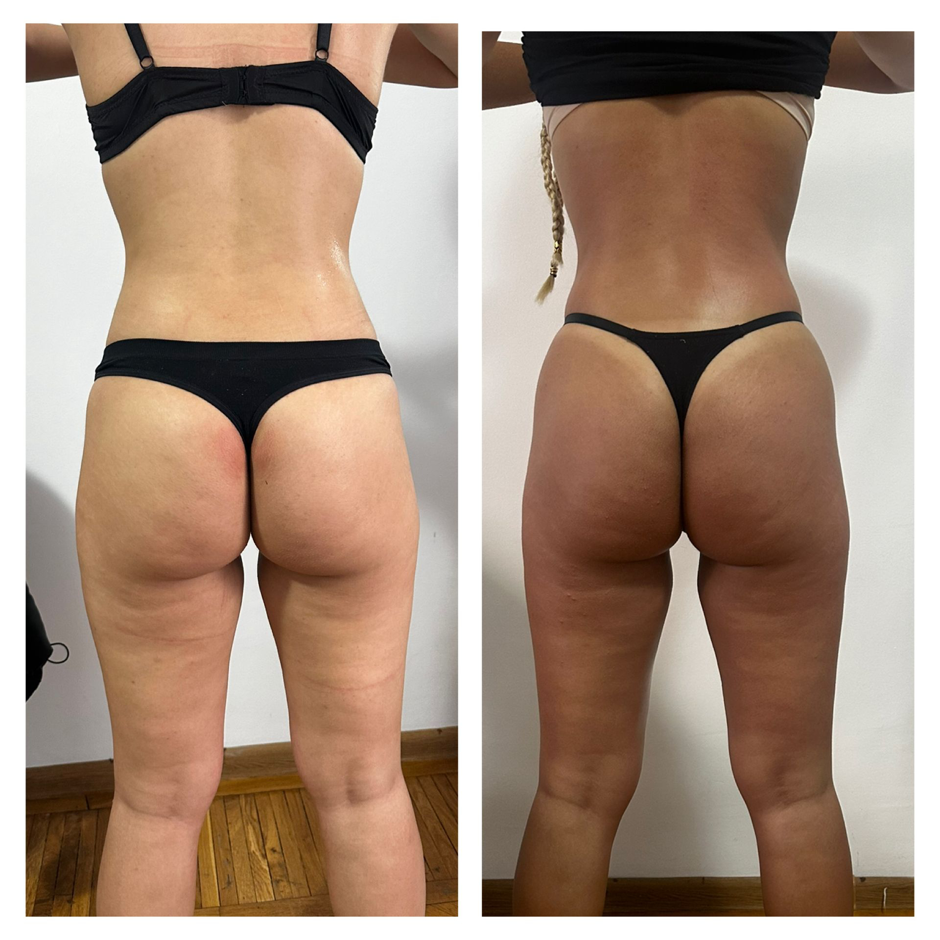 Remodelare corporala fata spate