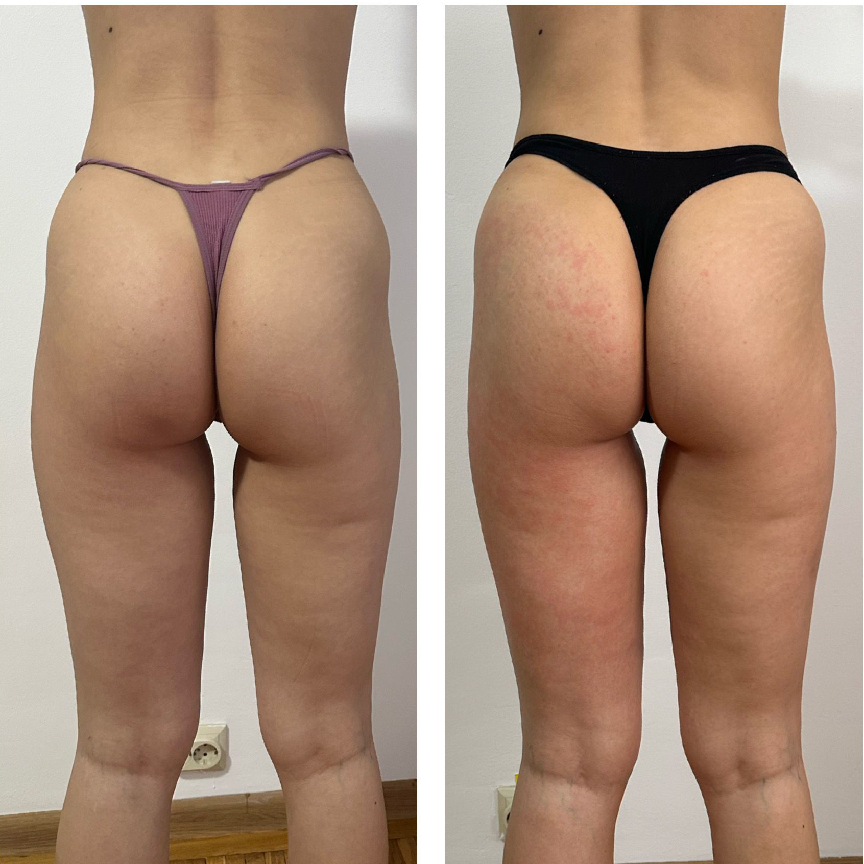 Rezultat vacuum fese spate