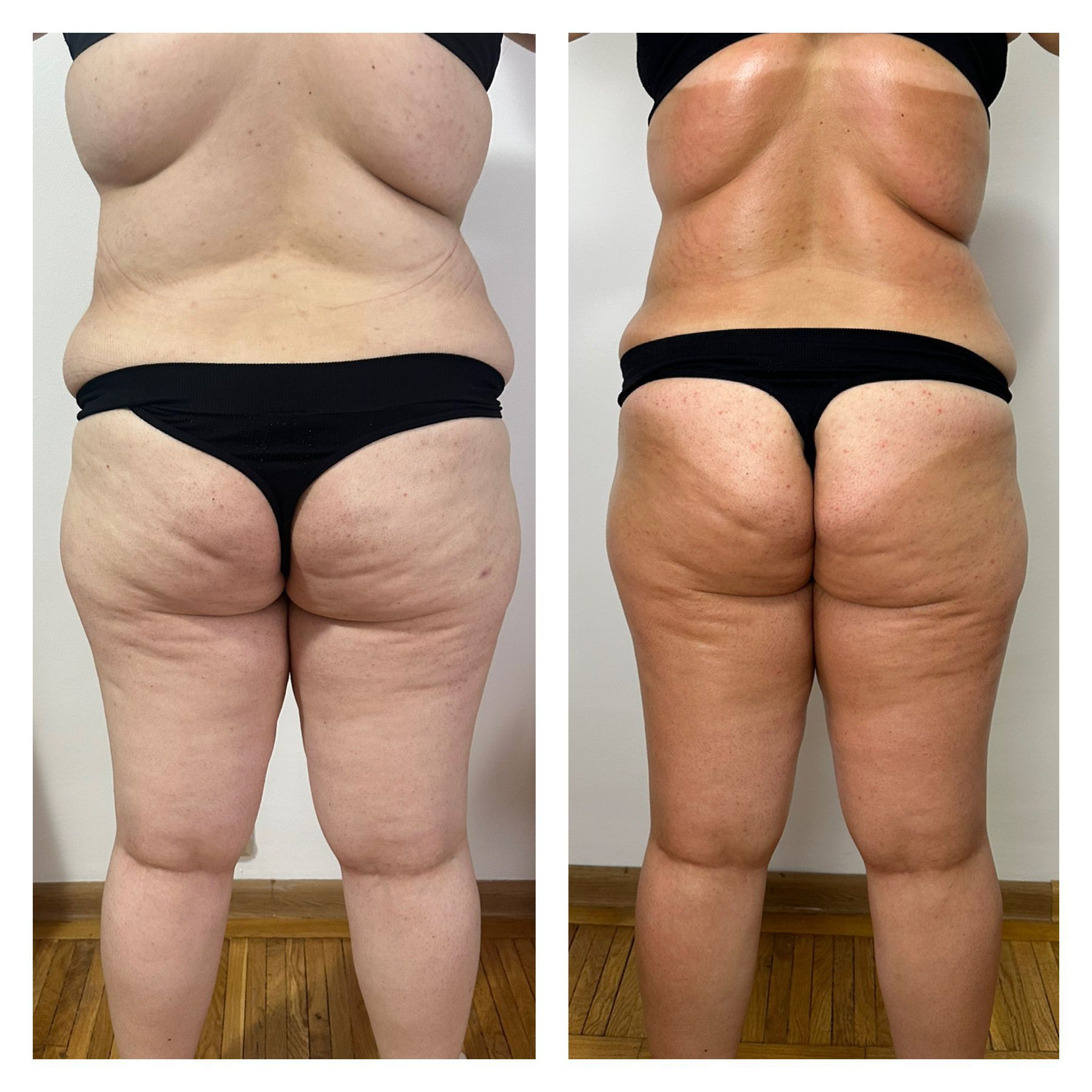 Remodelare corporala completa