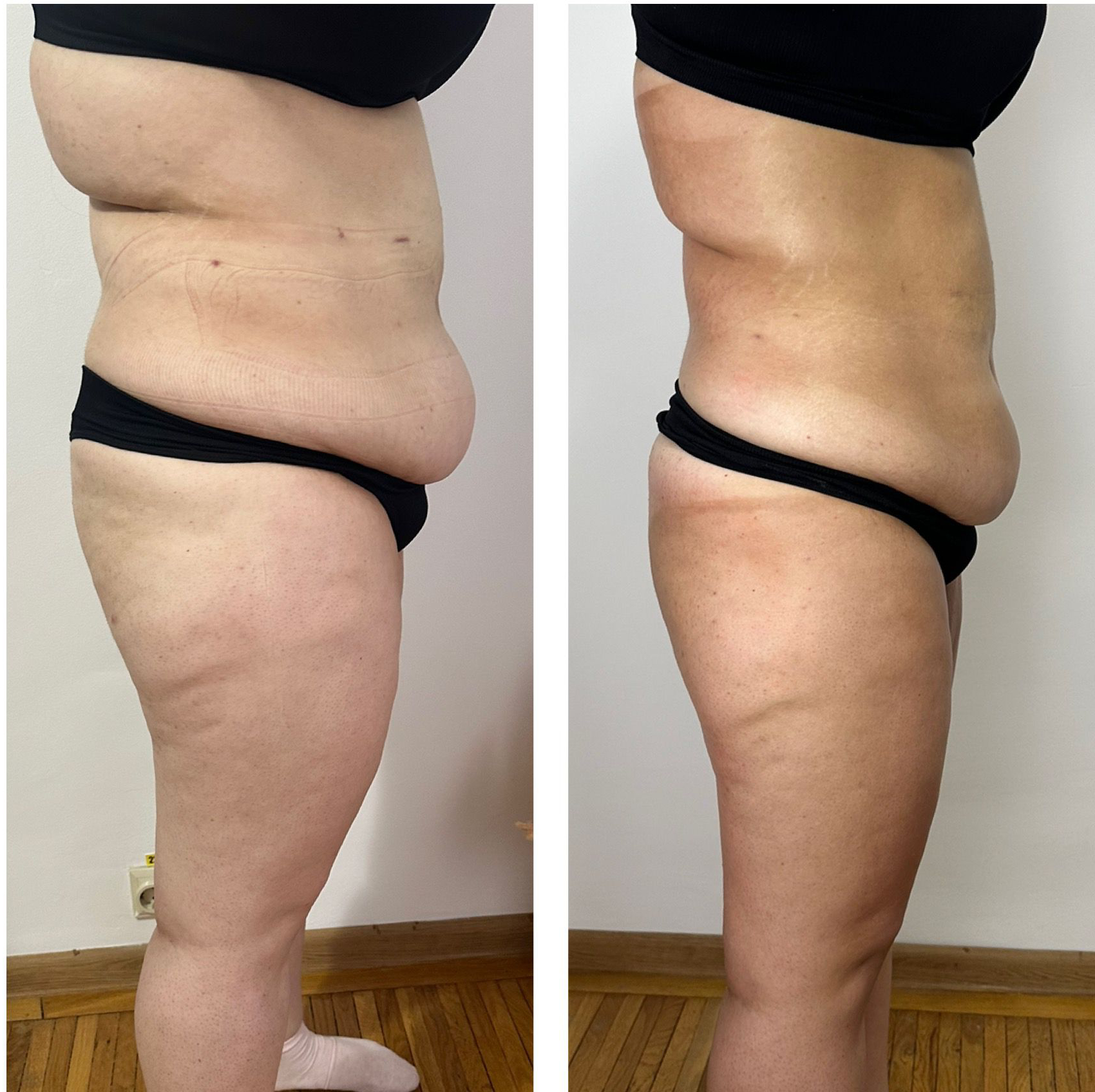 Remodelare abdomen profil