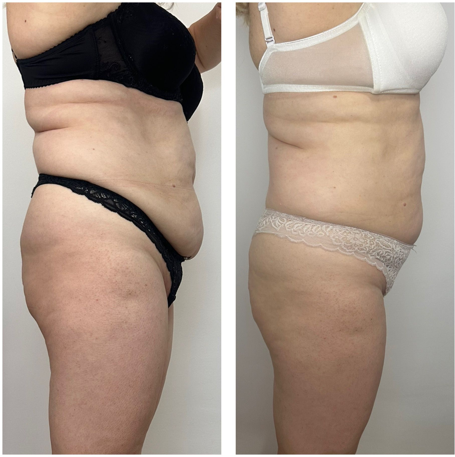 Remodelare abdomen - schimbare majora